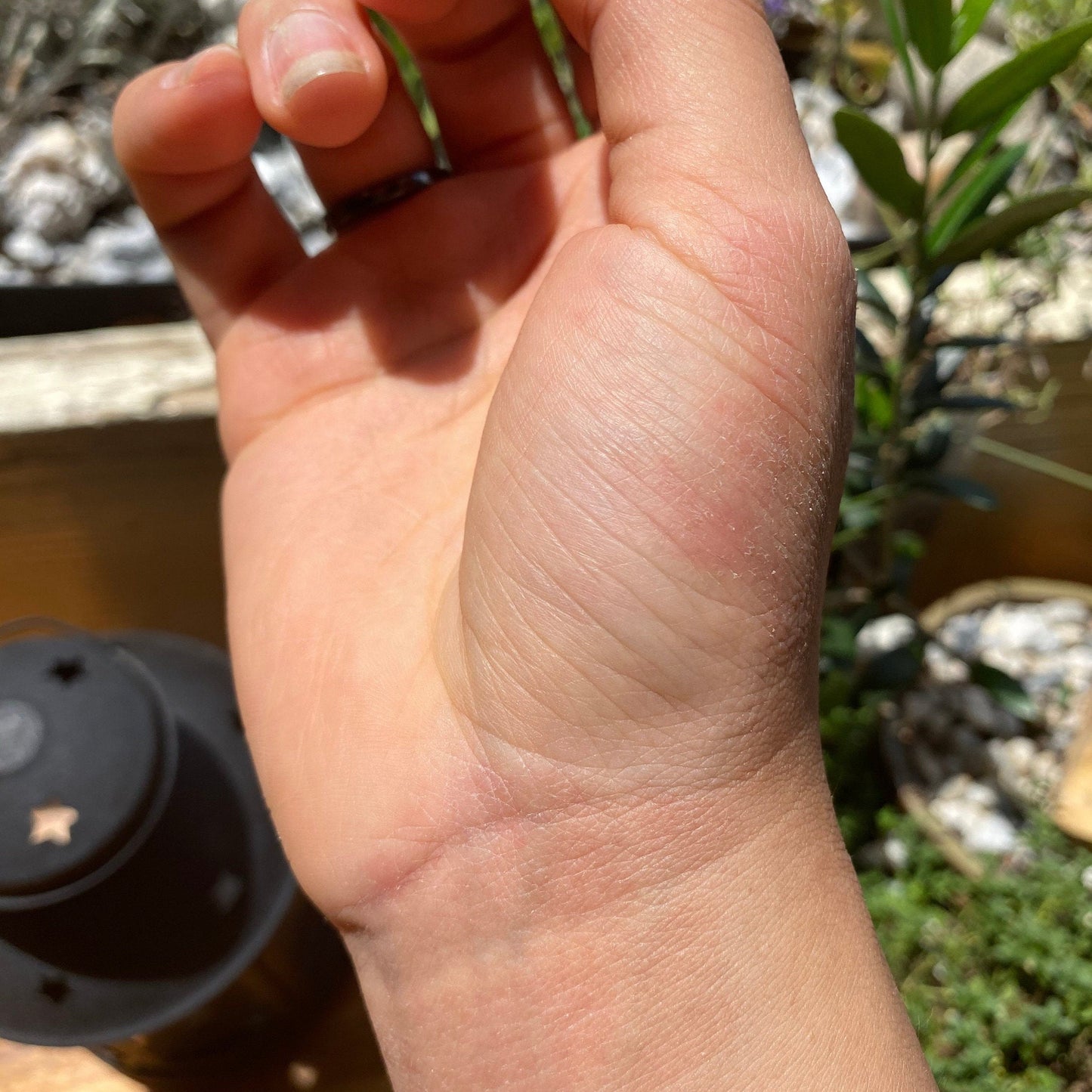 topical eczema on Hand