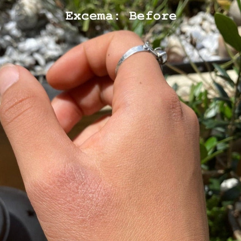 topical eczema on hand