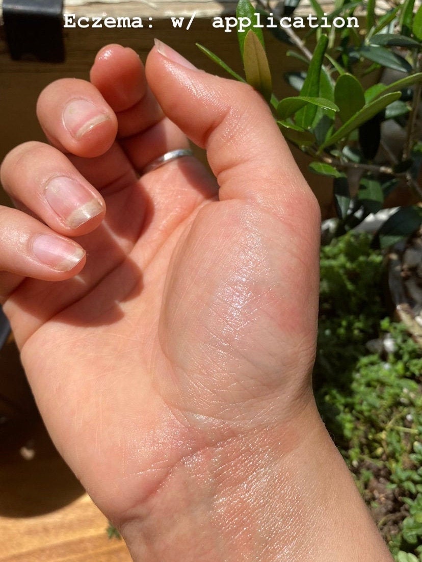 Yarrow salve on eczema