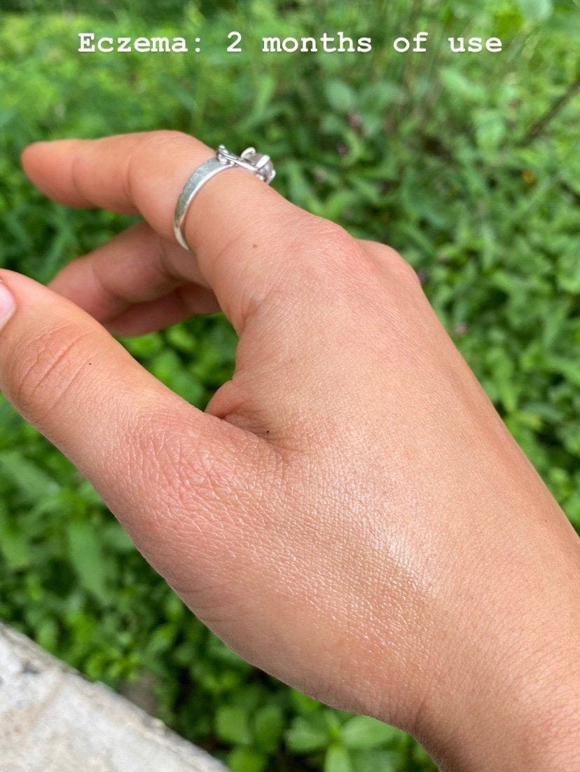 homemade healing salve on eczema